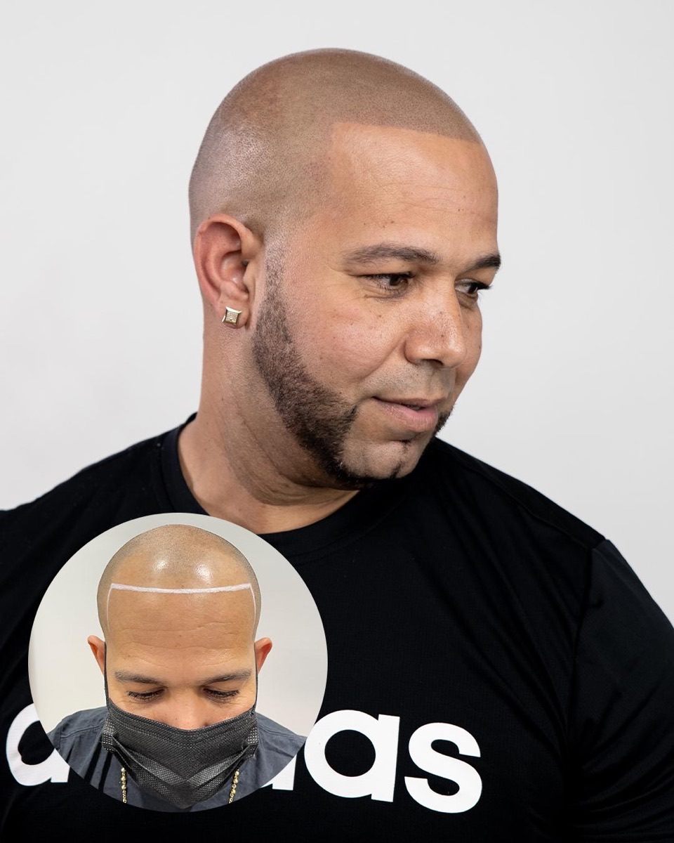 Scalp micropigmentation before and after at Erik Roberto SMP Studio