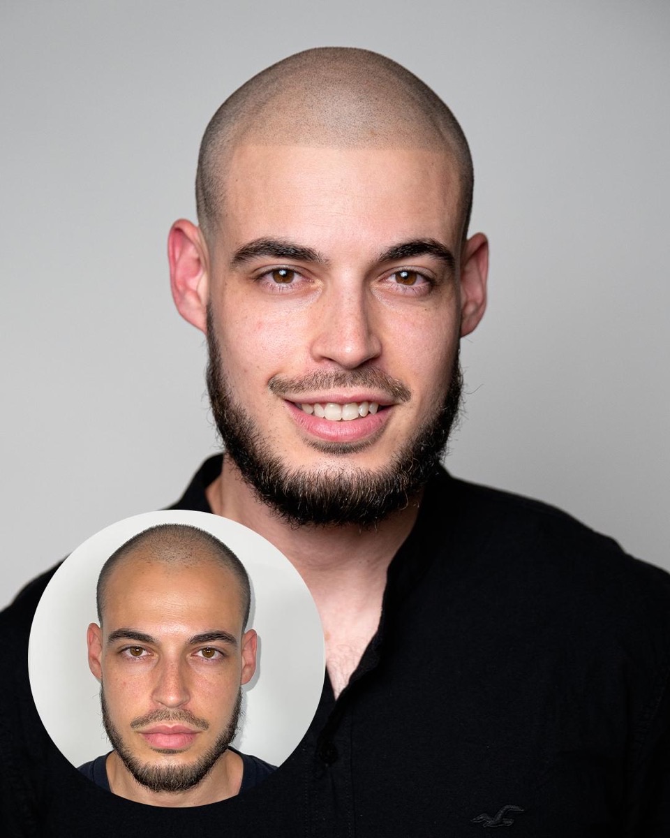 Scalp micropigmentation before and after at Erik Roberto SMP Studio