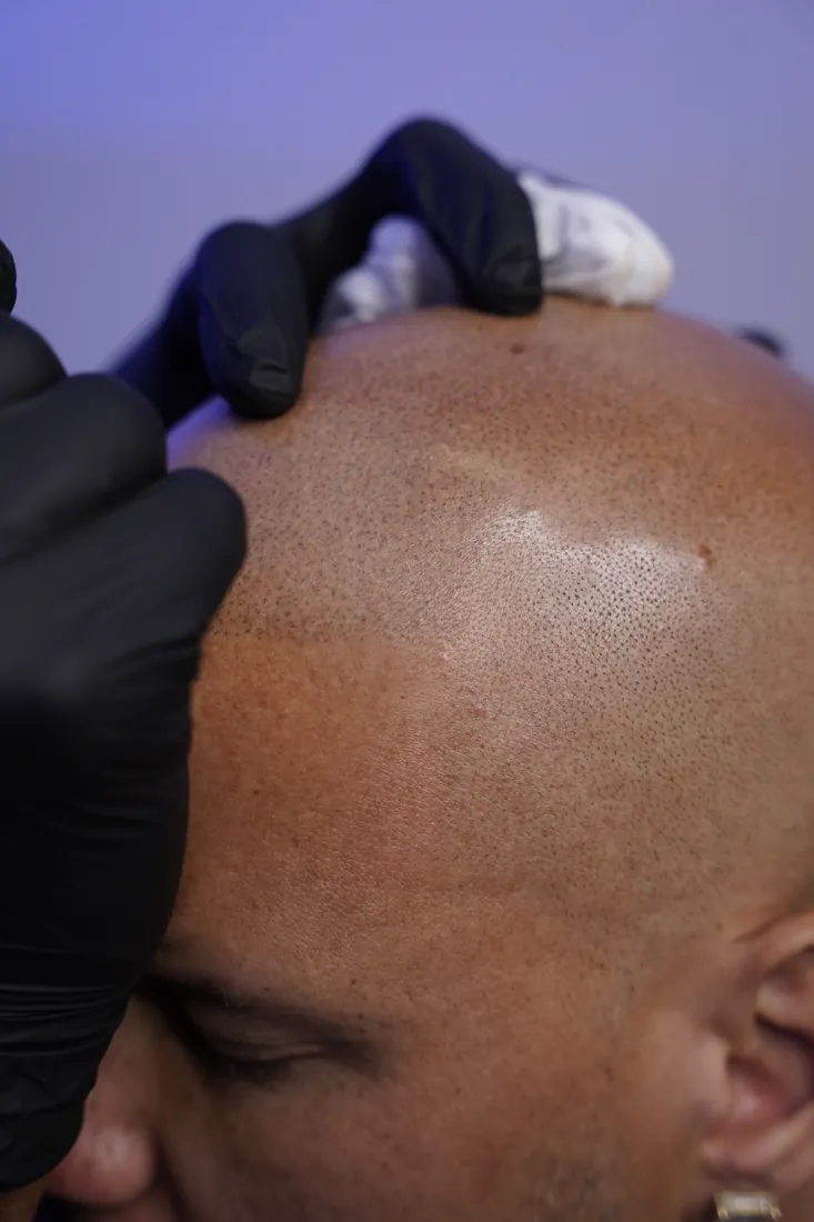 Detailed scalp micropigmentation density, up close